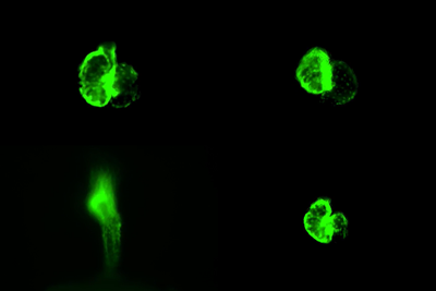 Four different hearts in various conditions, representing Barth syndrome and a potential therapy.