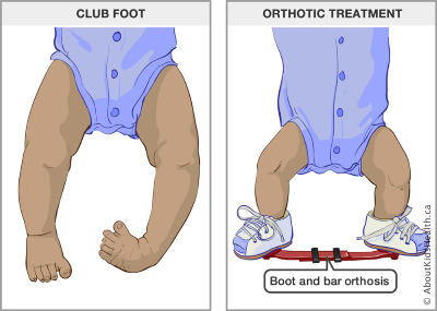 An illustration shows what a baby’s legs and feet look like with club foot and how the boot and bar orthosis is worn to treat club foot. 