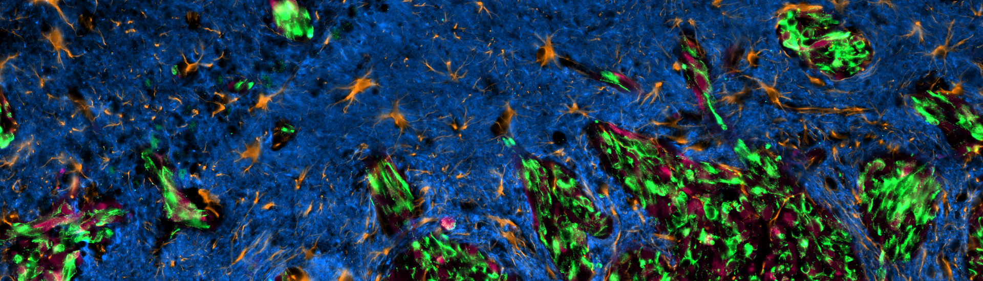 A fluorescent image of glioblastoma cells (green) scattered among healthy brain tissue (blue).