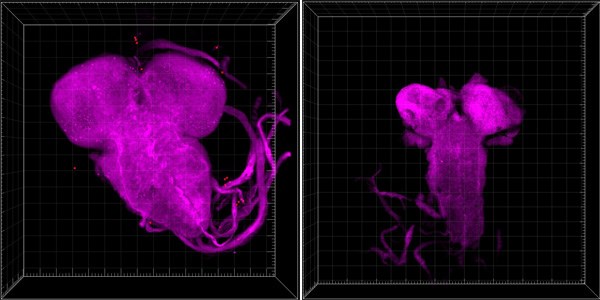 Scans of a glioma. The scans appear purple on a black background.