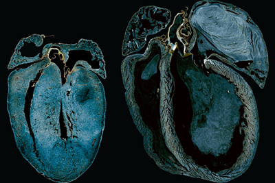 Two hearts, one with normal energy production and one, larger, showing an energy production deficiency. 