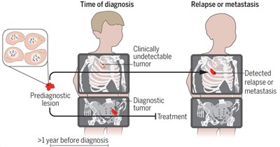 Graphic that shows a child with a clinically undetectable tumour as well as a diagnostic tumour at the time of diagnosis. It then shows another child who is in relapse or metastasis. The previously clinically undetectable tumour has grown and is not labeled as a detected relapse or metastasis.