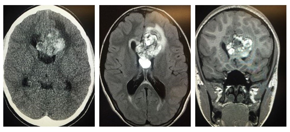 Three brain scans side by side.