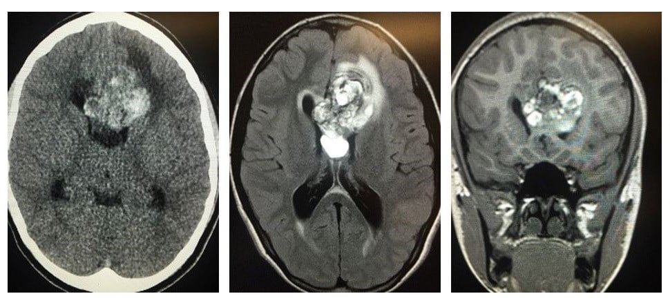 Three brain scans side by side.