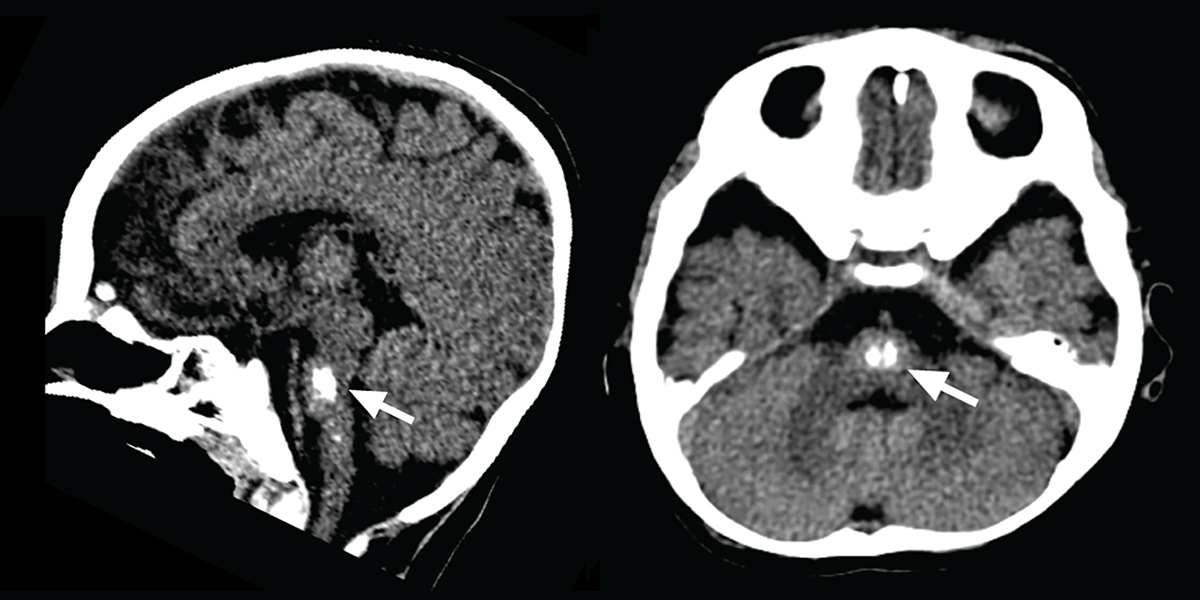 A scan of a brain stem showing brain calcifications.