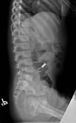 X ray showing a spine with a small bright spot inside the rib cage.