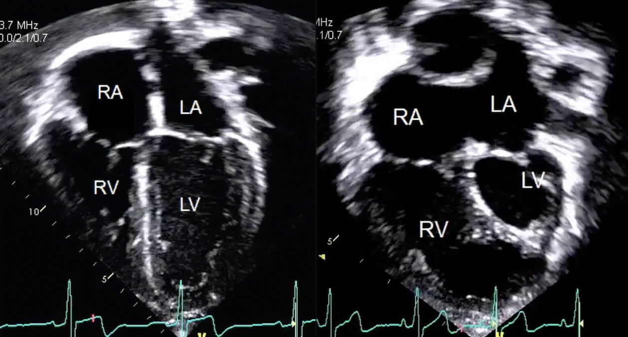 The Echocardiography Laboratory provides diagnostic cardiac ultrasound for children with suspected or known heart disease. The left panel shows an echocardiographic four-chamber view of a normal heart demonstrating the right atrium (RA), the right ventricle (RV), the left atrium (LA), and the left ventricle (LV). The right panel shows a four-chamber view of a heart with hypoplastic left heart syndrome, note the small left ventricle and dilated right ventricle.  