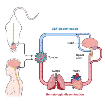 Diagram shows a tumour in a mouse and a human. The diagram shows how hematologic dissemination and CSF dissemination flow through the brain, spinal cord, heart, lungs and tumour.