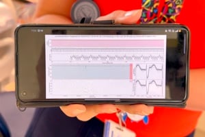 Myocardial Perfusion (MIBI) scan