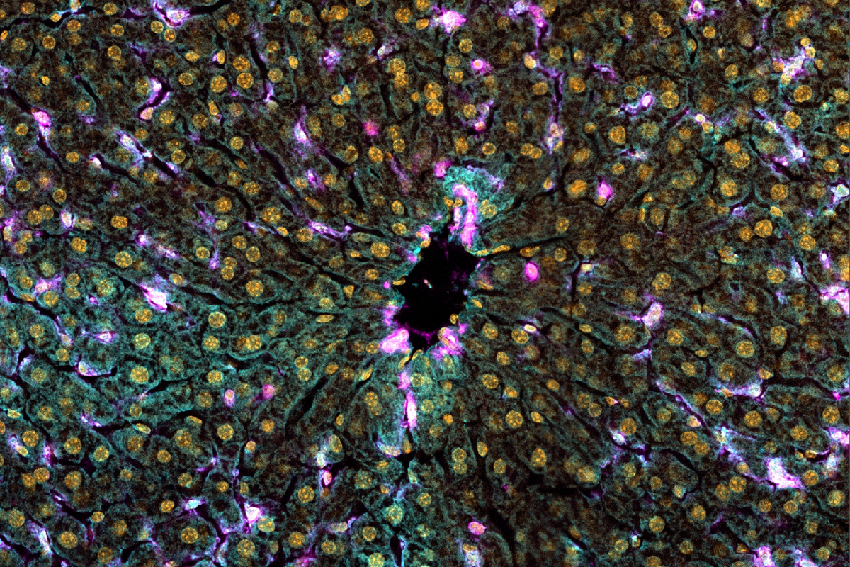 Image of liver's cells and architecture that shows cell death and tissue damage  