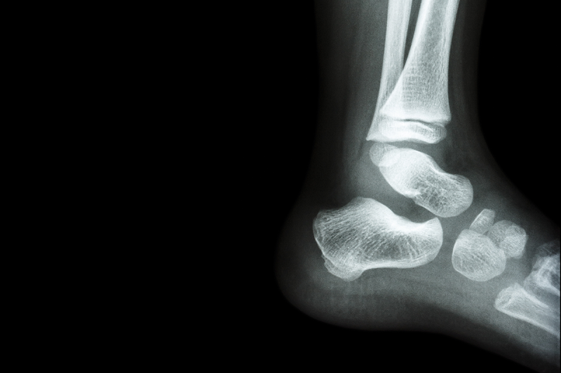 An x-ray of an ankle.