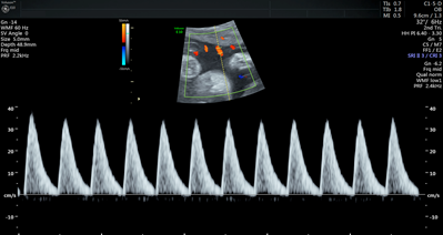 Black and white graph showing sharp spikes and valleys.