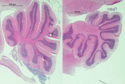 Two side by side stains of a brain tumour, the right showing reduced growth.