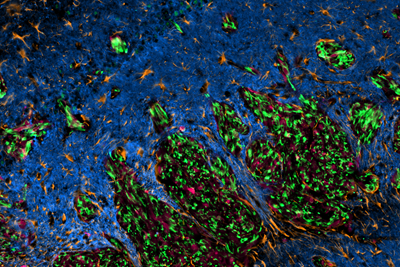 A fluorescent image of glioblastoma cells (green) scattered among healthy tissue (blue).