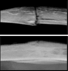 Two x-rays. One shows a broken bone, one shows a bone that is not broken.