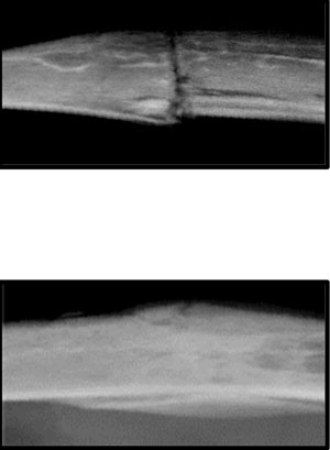 Two bone xrays. Top xray shows an old bone with more texture, indicating deposits of weak fibrotic tissue. bottom image shows a young bone with much less texture.