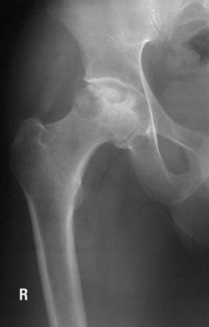 An x-ray showing a damaged hip bone.
