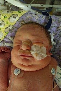 A small baby with a swollen face and tube up her nose lies in hospital bed