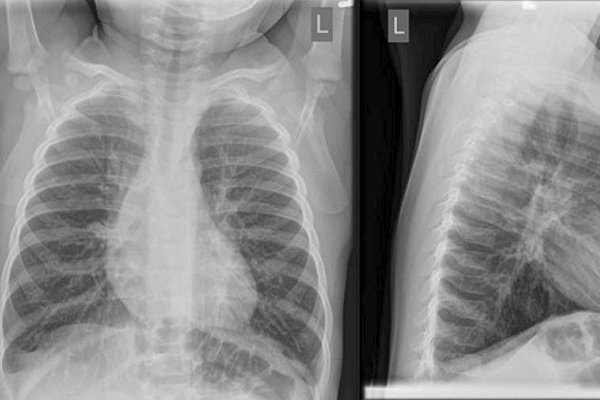 Chest x-ray.