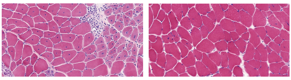 A side-by-side comparison of microscopic images of cells. The cells in the first image are lighter pink with many blue spots and abnormalities throughout, and the cells in the second image are more pink with less abnormalities.