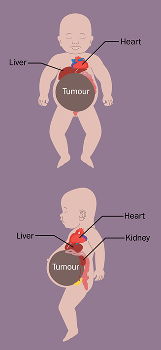 Two graphic illustrations of an infant with a large abdominal tumour. The first illustration shows the tumor's placement beneath the liver and heart. The second shows the tumour on top of the kidney and on top of the bladder