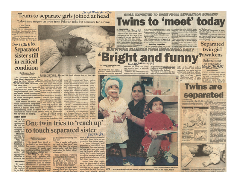 Collage of yellowed newspaper articles featuring photos of twins joined at the head.
