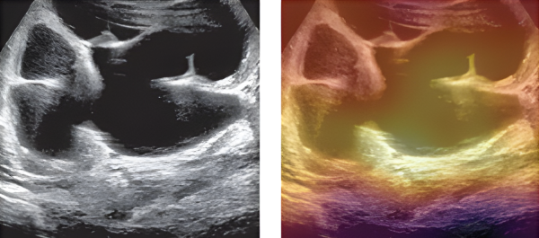 Two ultrasounds of kidneys, the image on the right is covered in a colourful layer that indicates an AI model has read it.