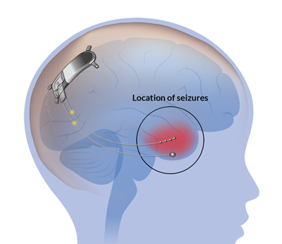 A diagram showing a cross section of a child's brain from the side. The temporal lobe is glowing red and circled, with a label that says "Location of seizures". Two electrodes are attached to the circled area, which are connected to a small device planted on the back of the brain.