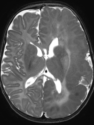 Brain MRI scan showing axial T2-weighted image of infant brain with visible ventricles.