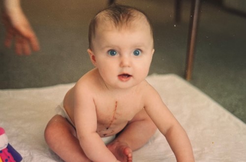 Six-month-old Liv sitting up with a scar on her chest.