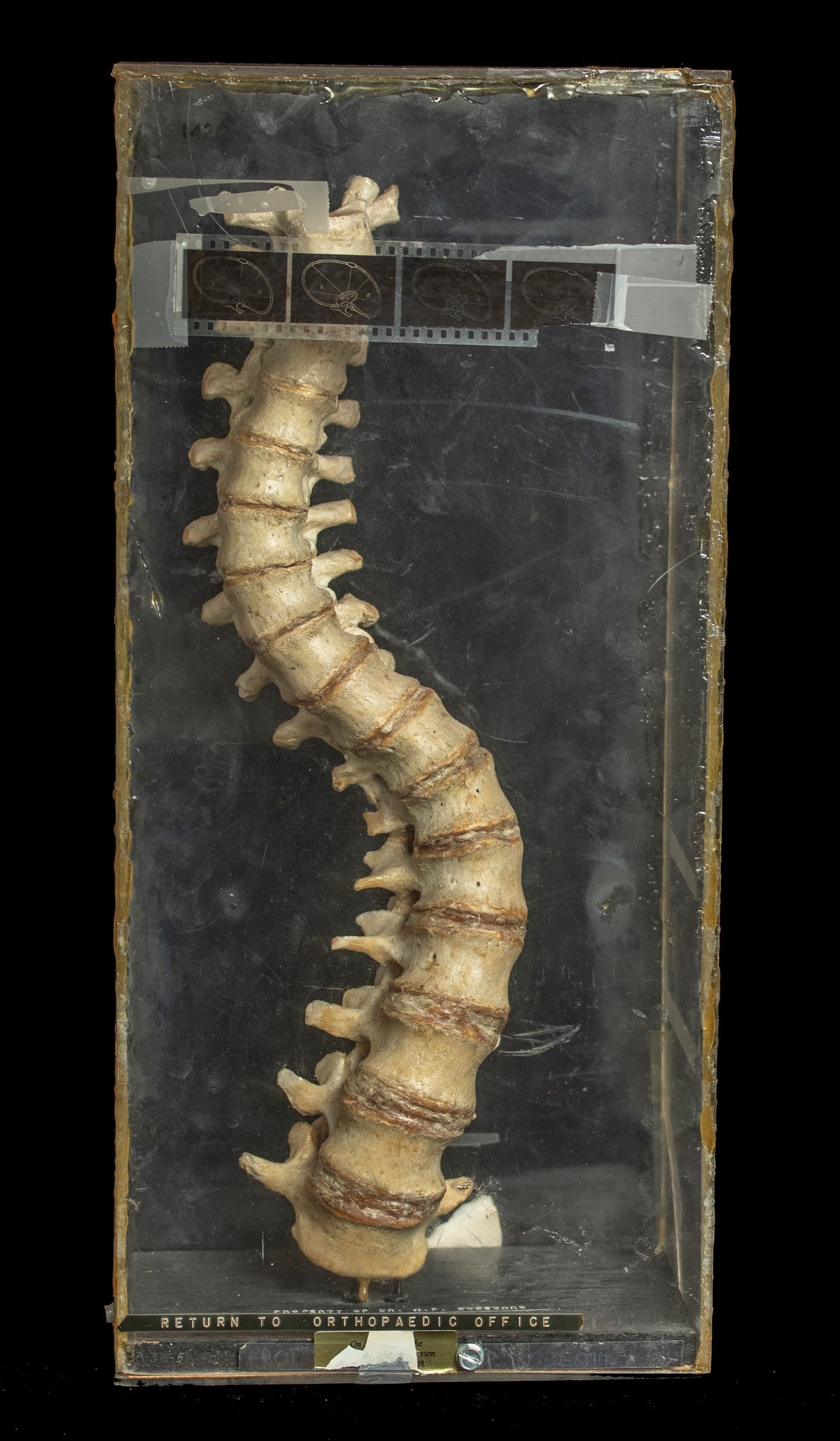 A spine curved in the shape of an S. The spine is displayed upright inside a clear display case.